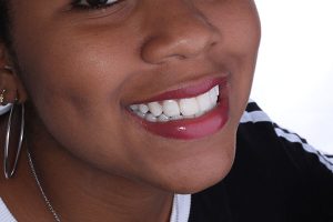 blanqueamiento-dental-medellin-oral-studio-4